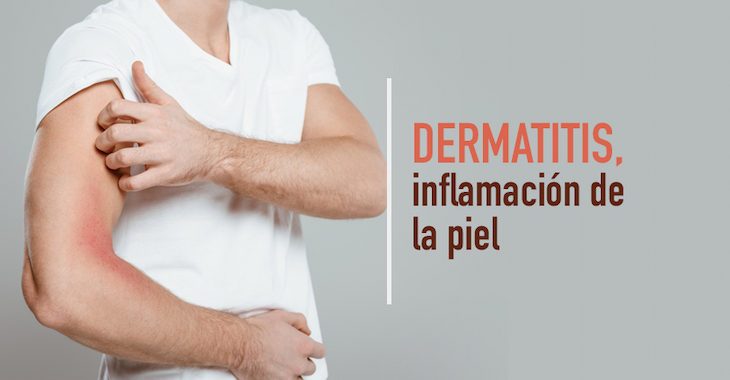 imagen del artículo Dermatitis, inflamación de la piel