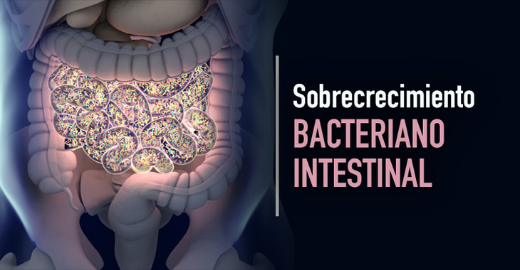 imagen del artículo Sobrecrecimiento bacteriano intestinal