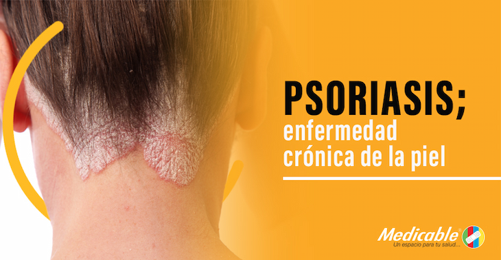 imagen del artículo Psoriasis; enfermedad crónica de la piel