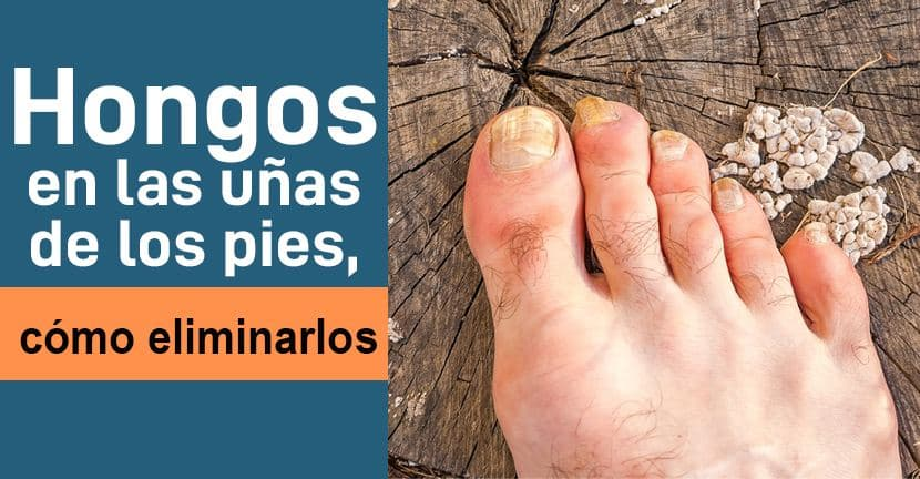 imagen del artículo Hongos en las uñas de los pies, cómo eliminarlos