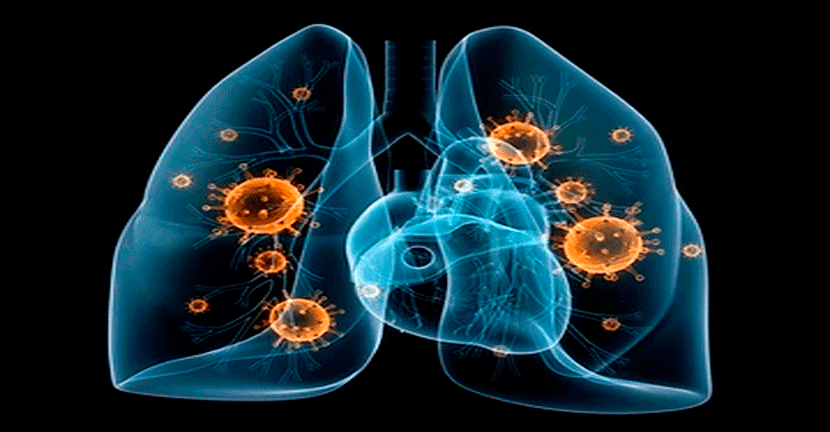 imagen del articulo Qué implicaciones tiene el COVID-19 en pacientes con cáncer de pulmón.