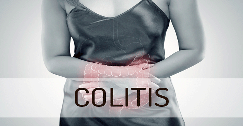 imagen del articulo Colitis