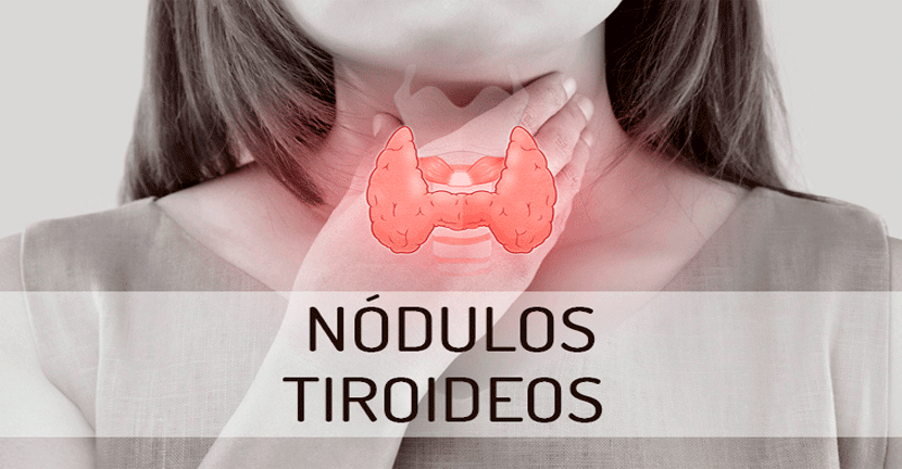 imagen del artículo Nódulos tiroideos