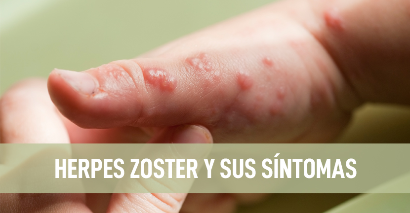 imagen del artículo Herpes Zoster y sus síntomas