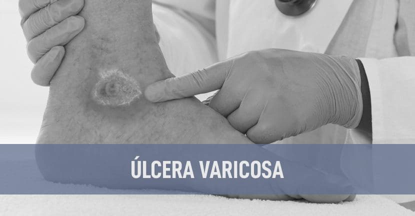 imagen del articulo Úlcera varicosa