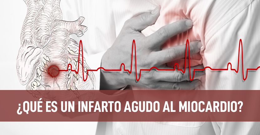 imagen del artículo ¿Qué es un infarto agudo al miocardio?