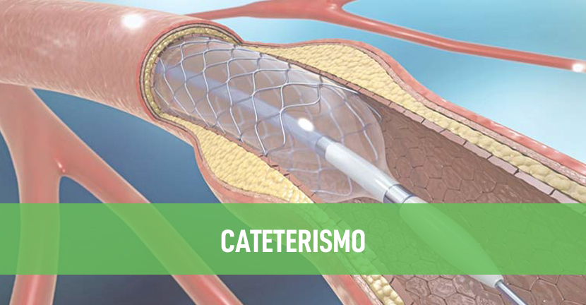 imagen del artículo Cateterismo
