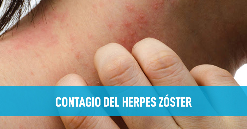 imagen del articulo Contagio del Herpes Zóster