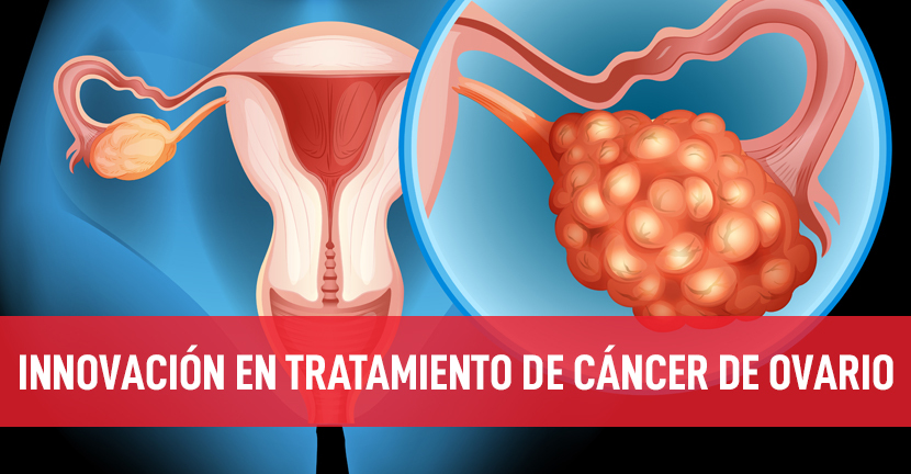imagen del articulo Innovación en tratamiento de cáncer de ovario
