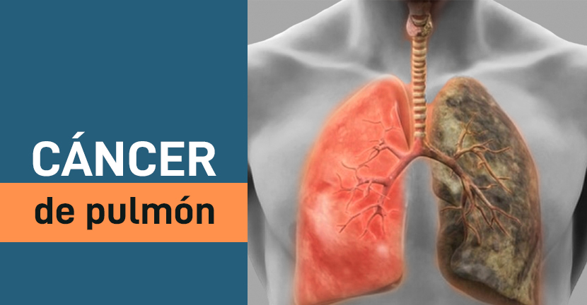imagen del artículo Acerca del cáncer de pulmón