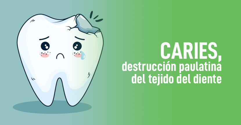imagen del artículo Caries, destrucción paulatina del tejido del diente