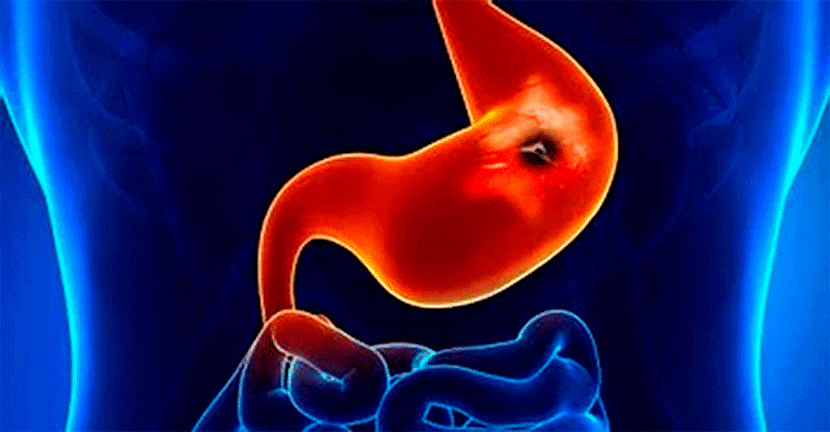 imagen del artículo Ardor y dolor abdominal pueden indicar la presencia de úlcera péptica