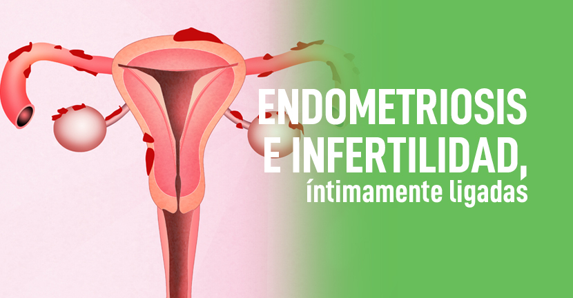 imagen del artículo Endometriosis e infertilidad, íntimamente ligadas