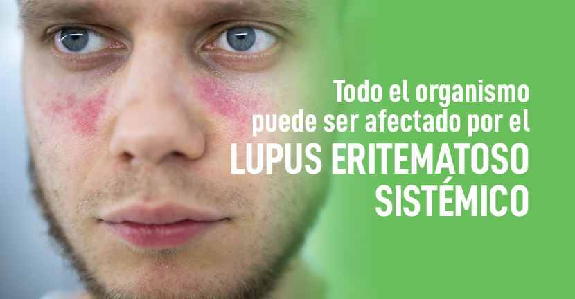 imagen del artículo Todo el organismo puede ser afectado por el Lupus Eritematoso Sistémico