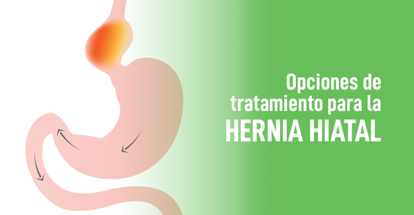 imagen del artículo Opciones de tratamiento para la hernia hiatal
