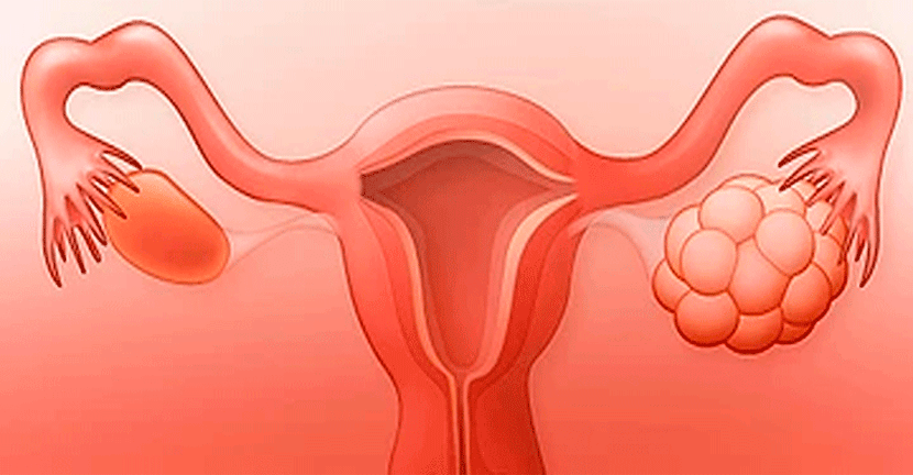 imagen del artículo Mujeres con síndrome de ovario poliquístico propensas a desarrollar diabetes