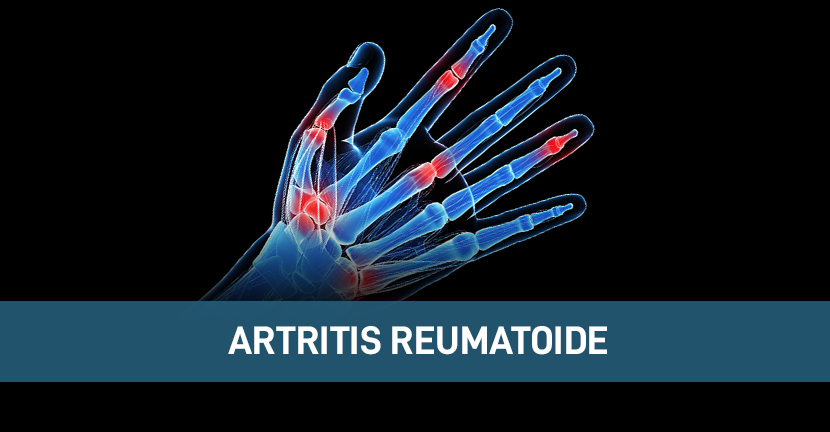 imagen del artículo Podrías tener Artritis Reumatoide y no saberlo