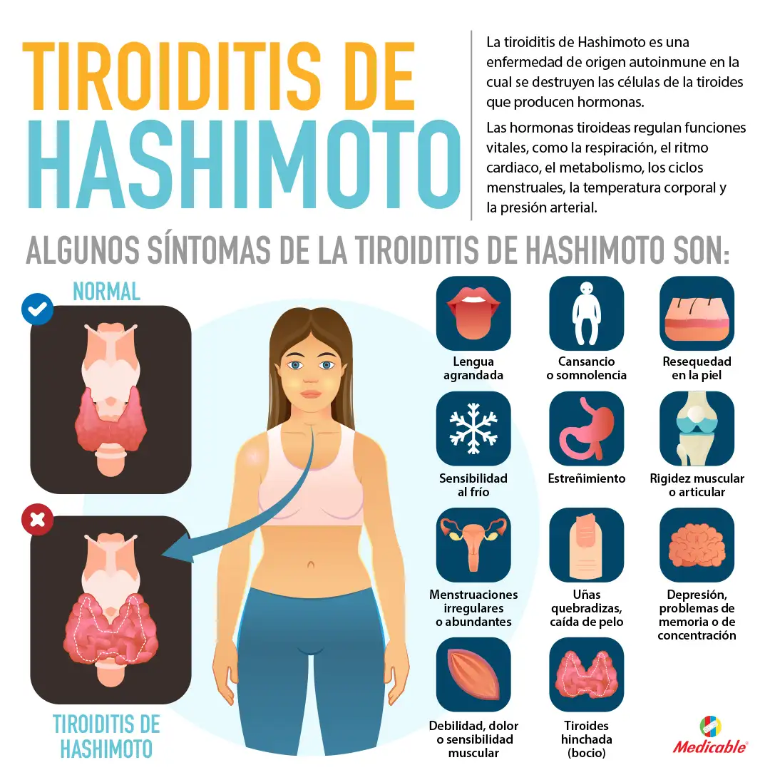 imagen de la infografia Tiroiditis de Hashimoto