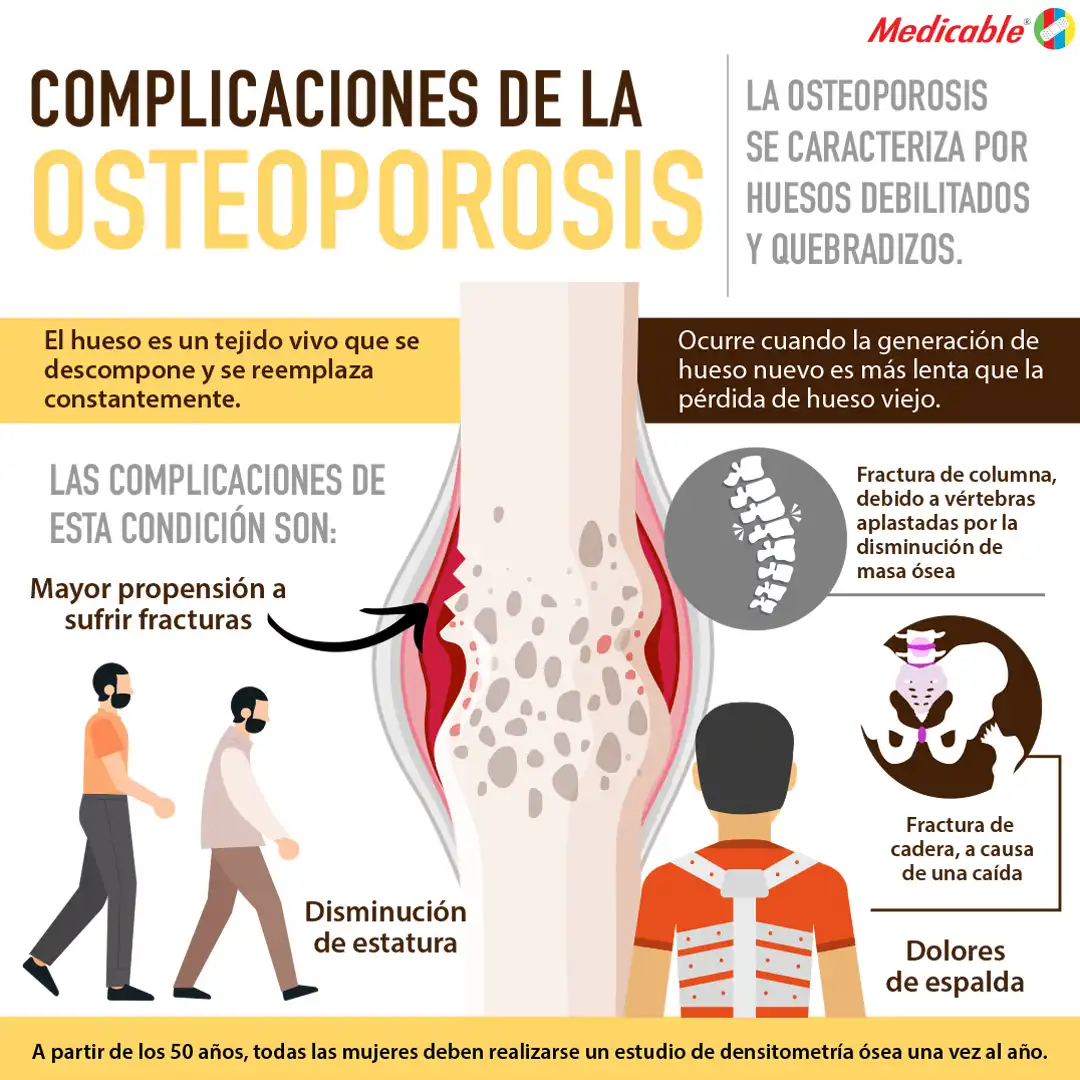 imagen de la infografia Complicaciones de la osteoporosis