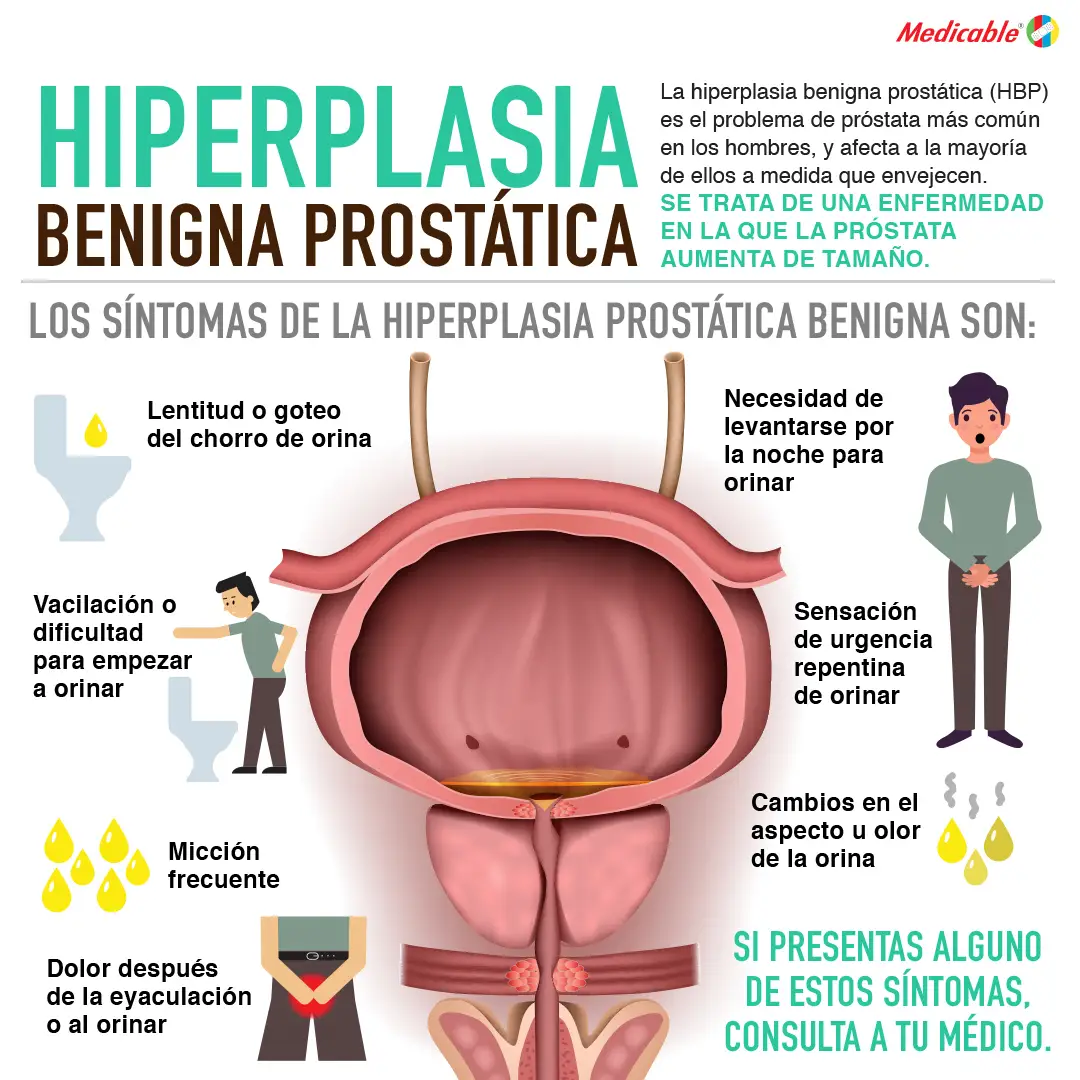 imagen del artículo Hiperplasia benigna prostática