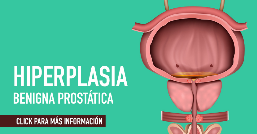 imagen de la infografia Hiperplasia benigna prostática
