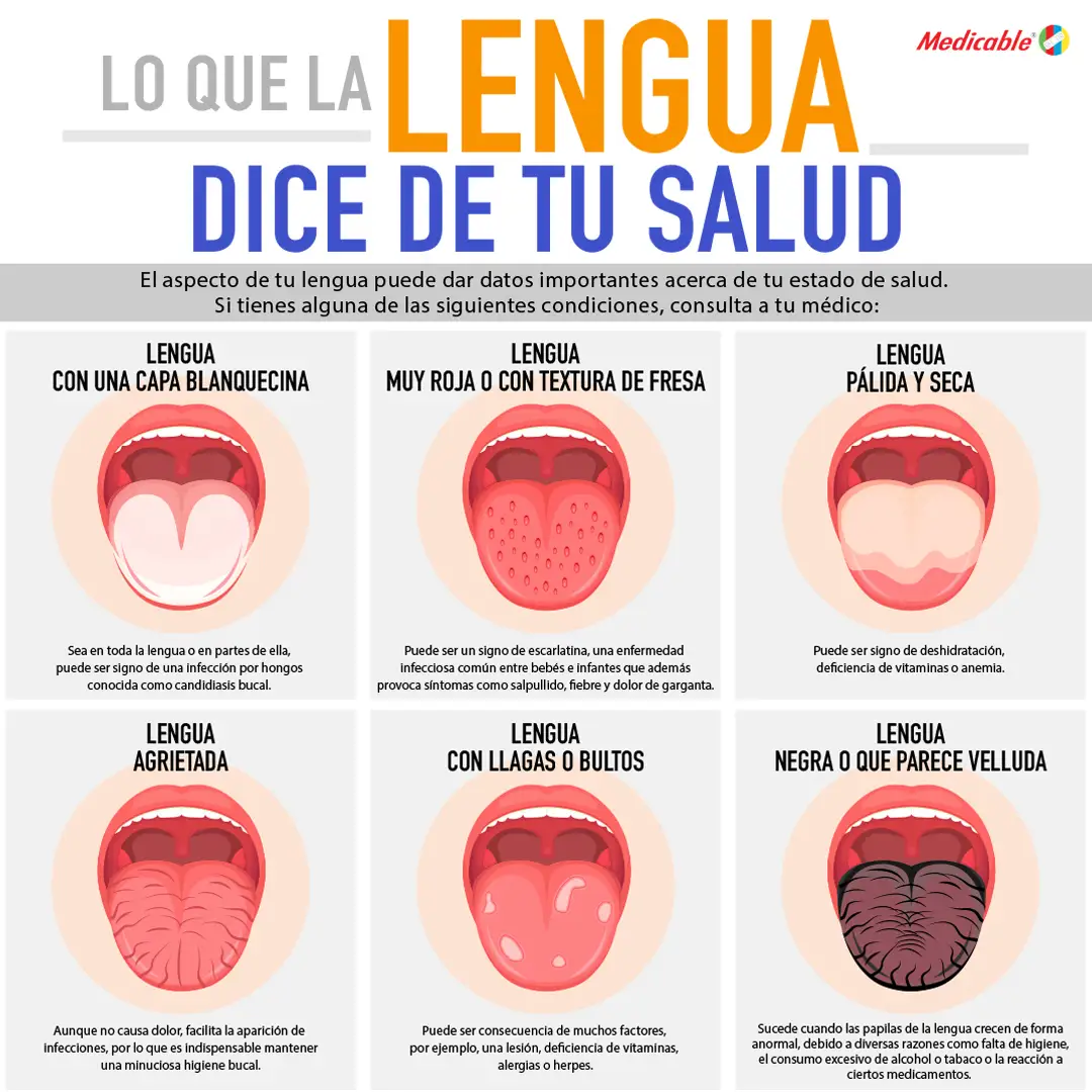 imagen de la infografia Lo que dice la lengua de tu salud 