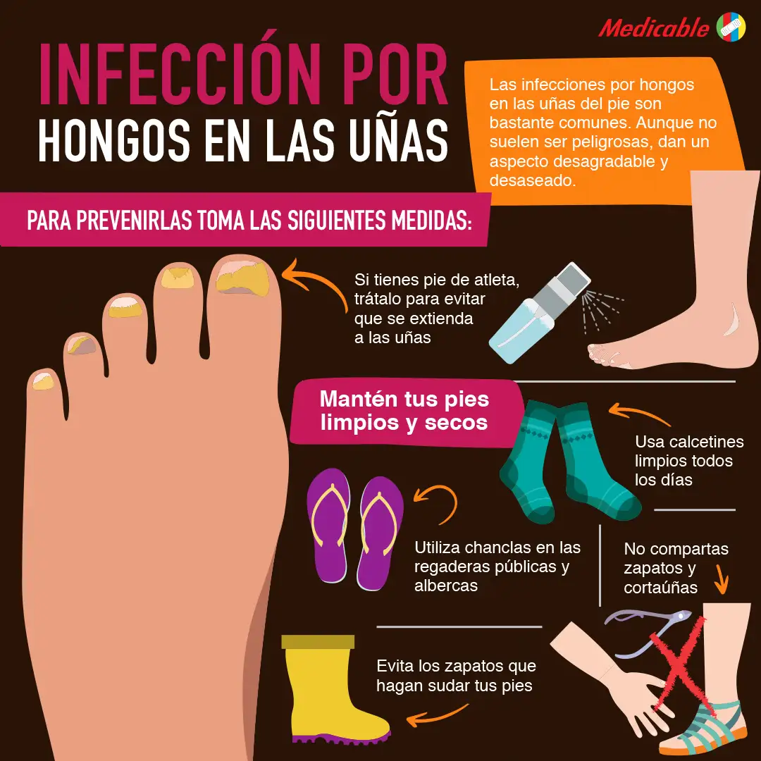 imagen de la infografia Hongos en las uñas de los pies