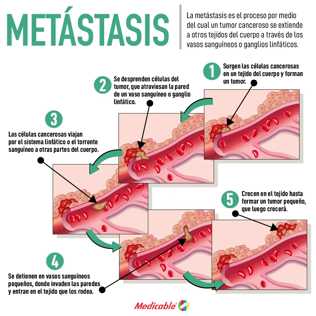 imagen del artículo Metástasis 