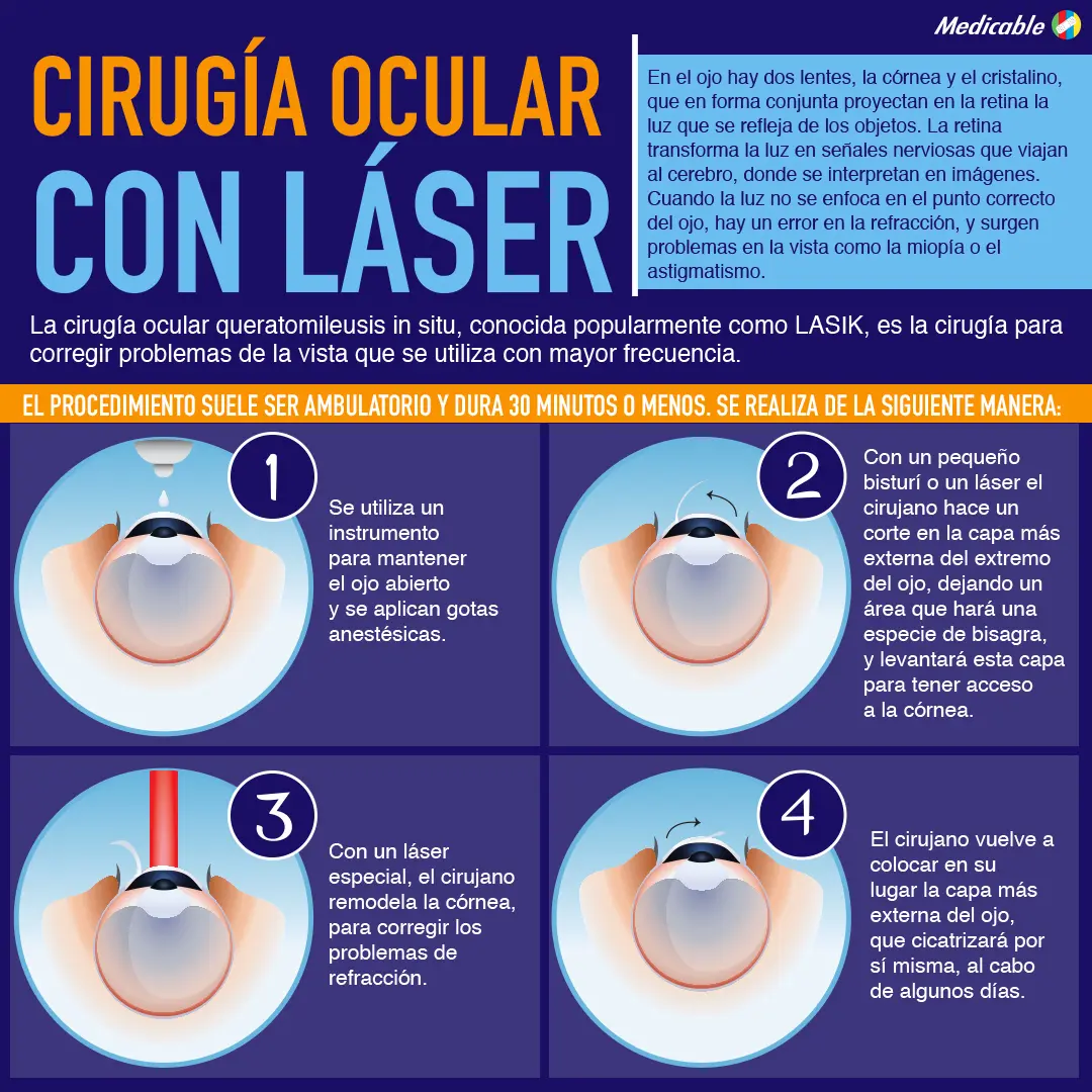 imagen de la infografia Cirugía ocular con láser 