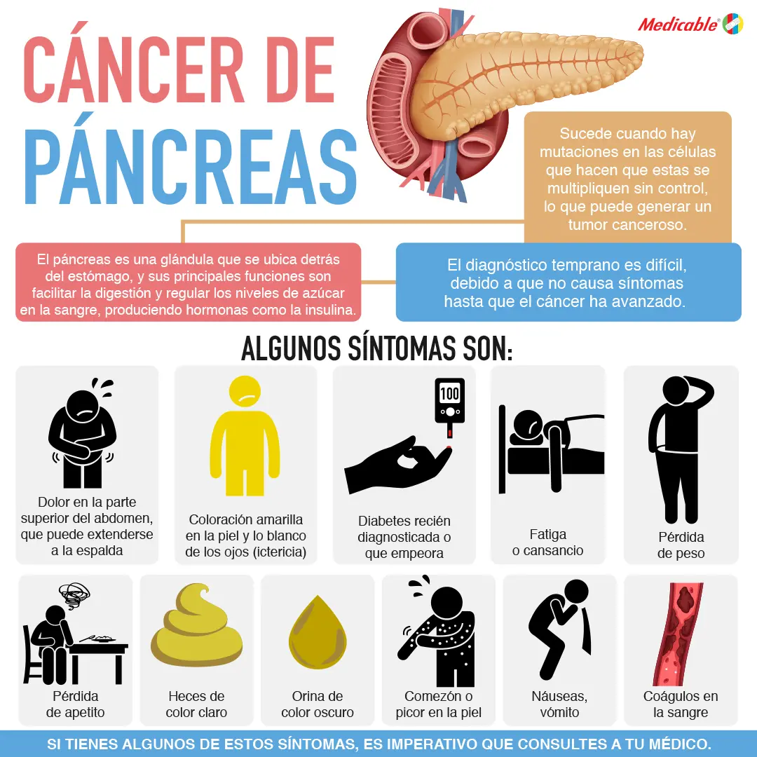 imagen del artículo Cáncer de pancreas