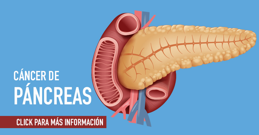 imagen de la infografia Cáncer de pancreas