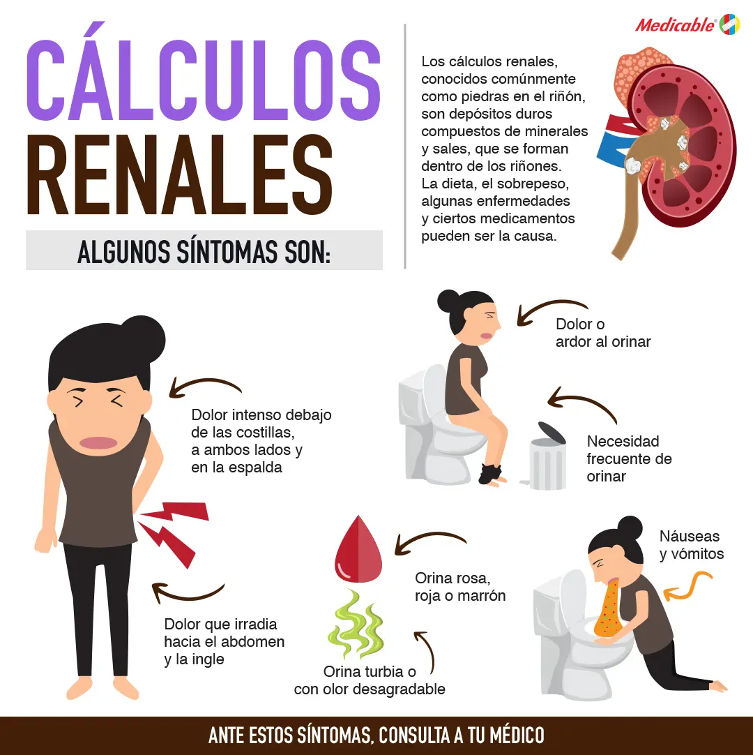 imagen de la infografia Cálculos renales