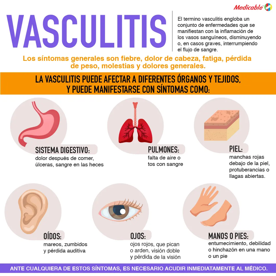 imagen de la infografia Vasculitis