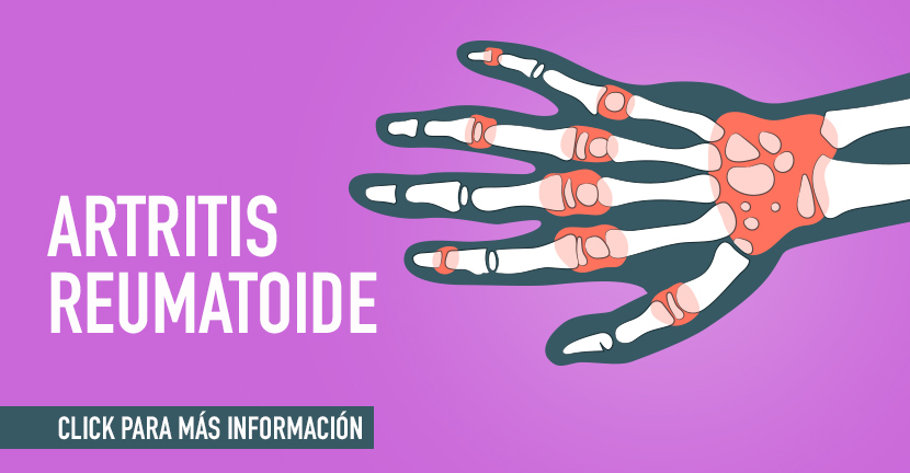 imagen de la infografia Artritis reumatoide recomendaciones dietéticas