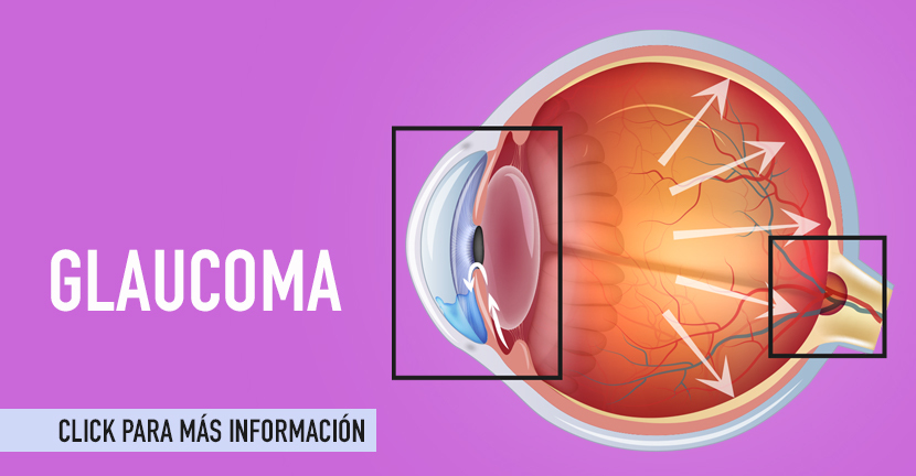imagen de la infografia Glaucoma