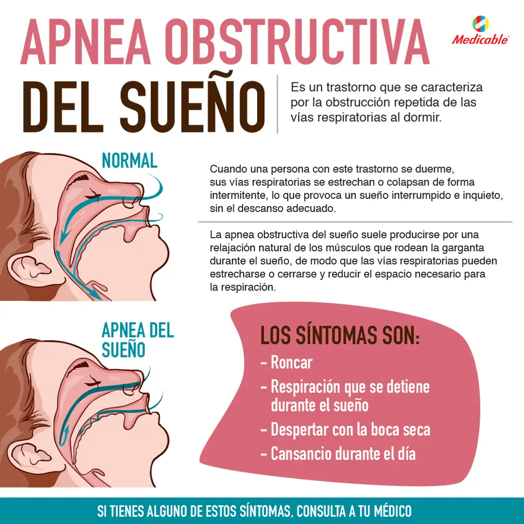 imagen de la infografia Apnea obstructiva del sueño