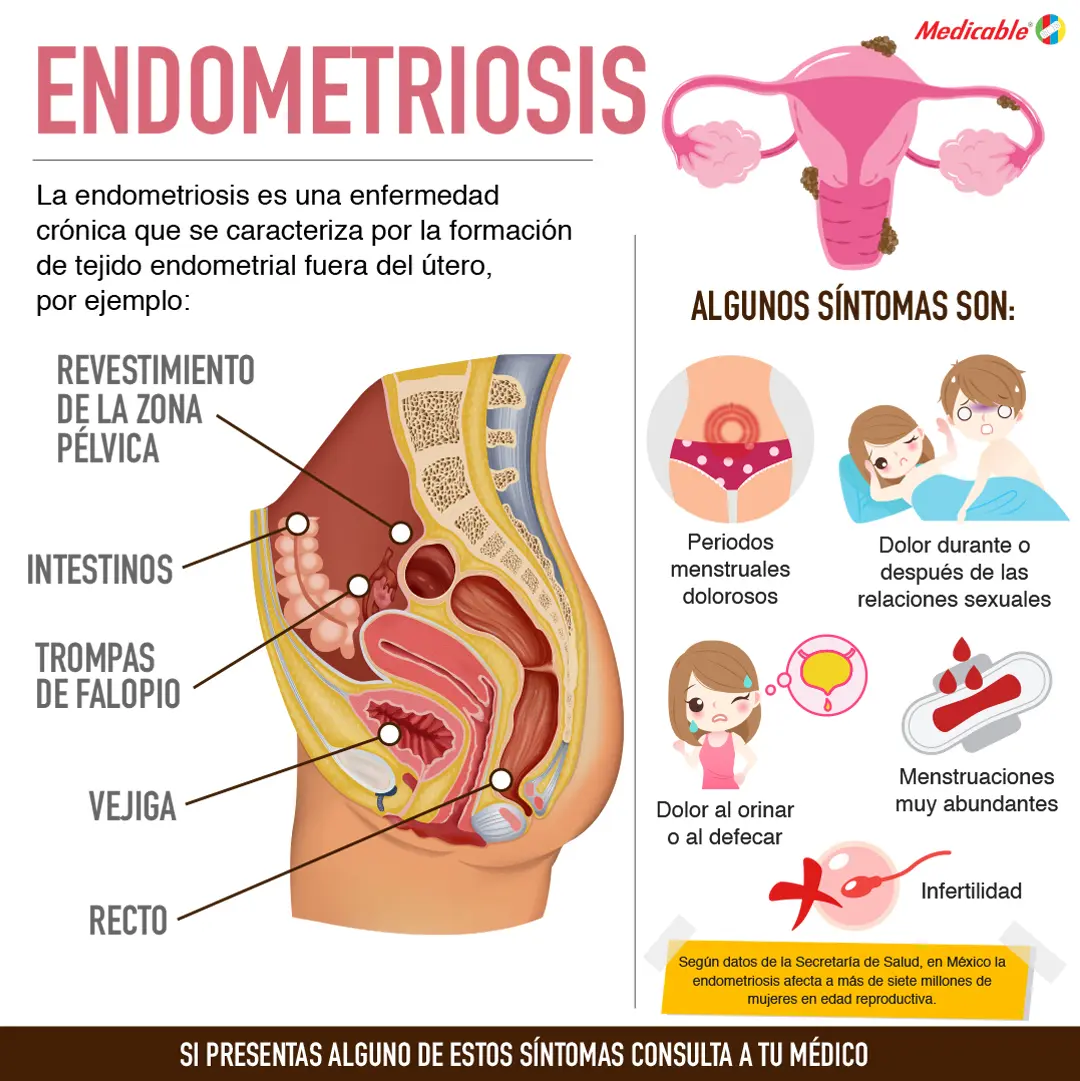 imagen del artículo Endometriosis