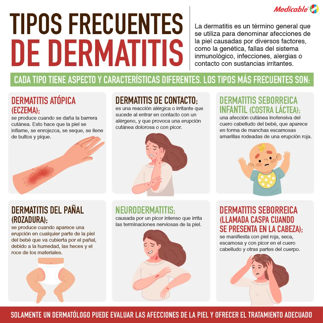 imagen de la infografia Tipos frecuentes de dermatitis