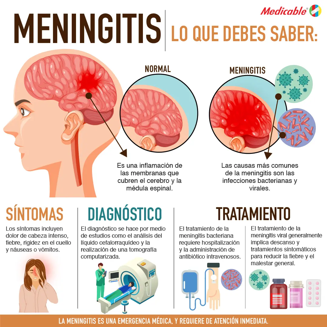 imagen del artículo Meningitis lo que debes saber