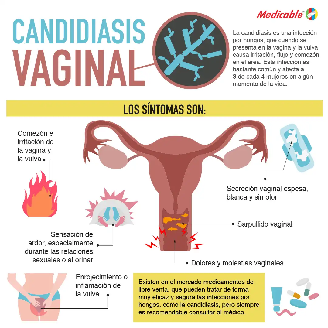 imagen de la infografia Candidiasis vaginal