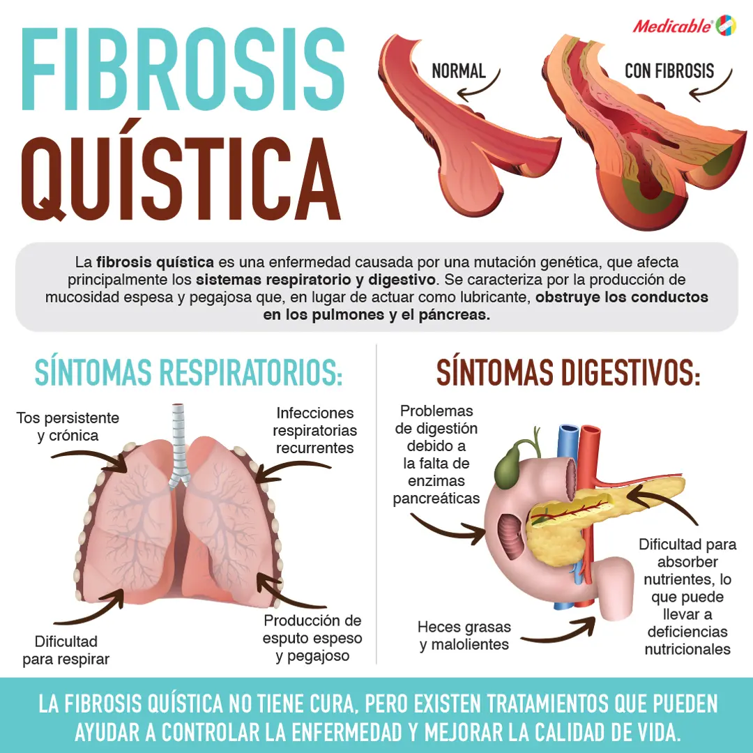 imagen de la infografia Fibrosis quística