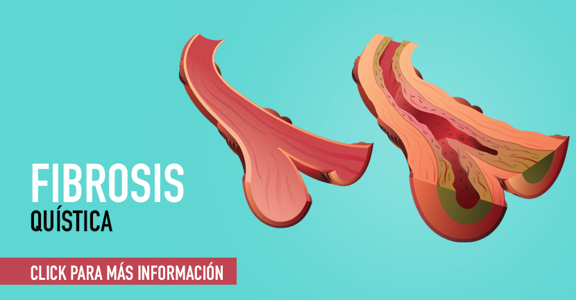 imagen de la infografia Fibrosis quística