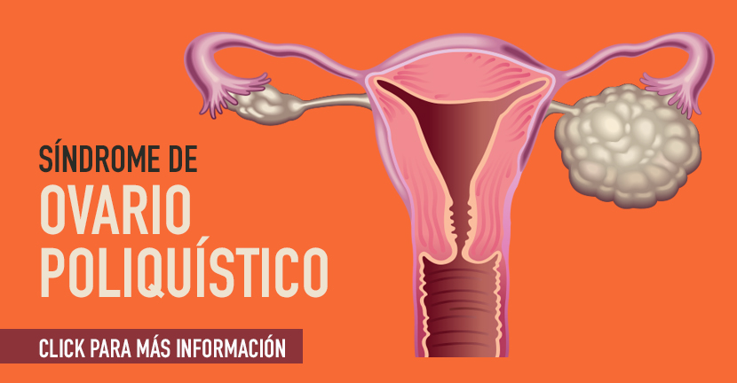 imagen de la infografia Sindrome de ovario poliquistico 
