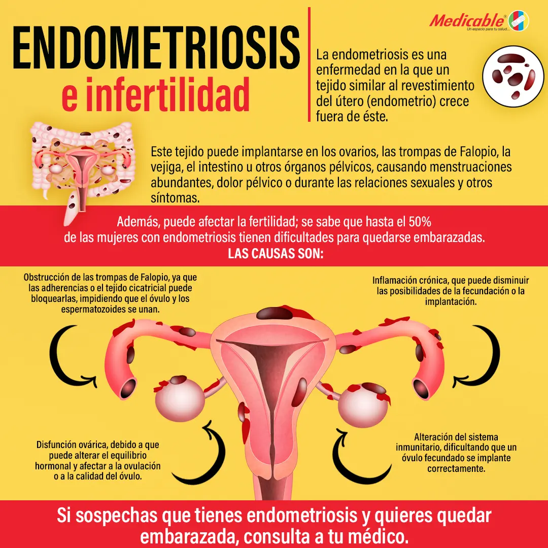 imagen de la infografia Endometriosis e infertilidad