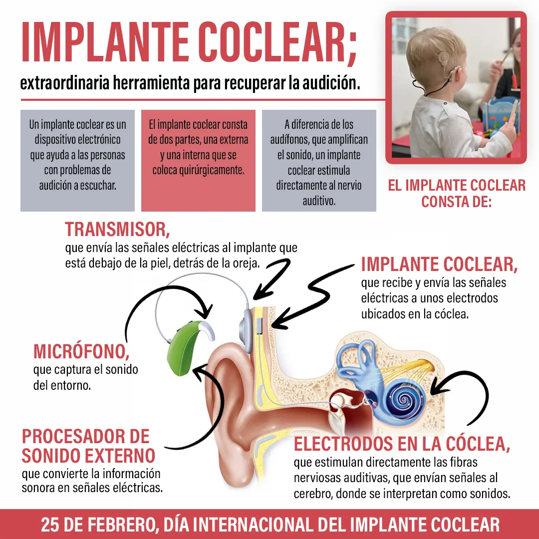 imagen de la infografia Implante coclear, extraordinaria herramienta para recuperar la audición