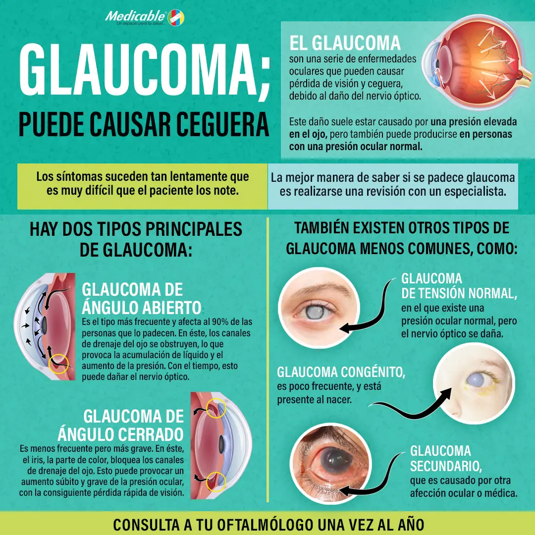 imagen de la infografia Glaucoma, puede causar ceguera