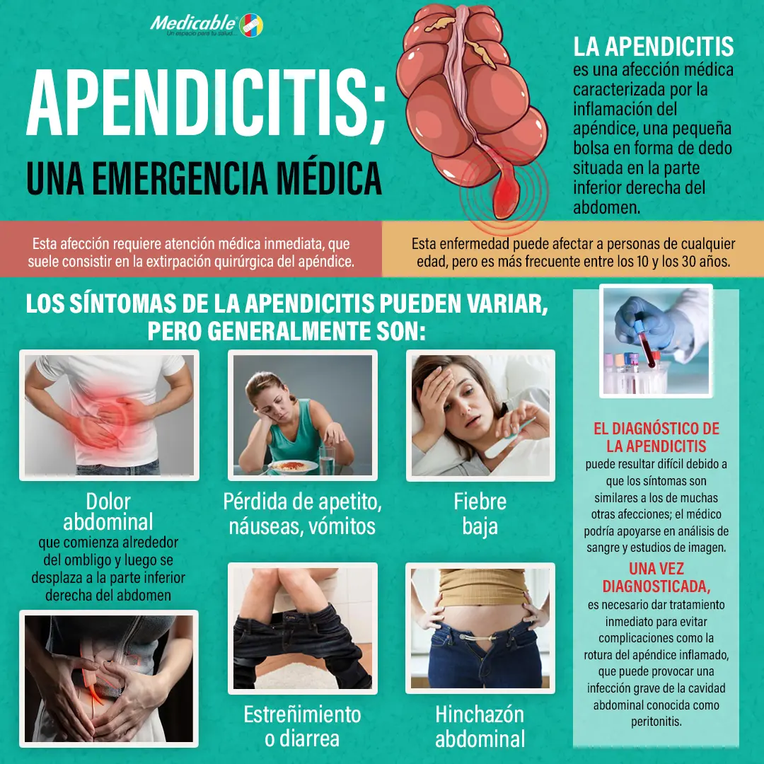 imagen de la infografia Apendicitis una emergencia médica