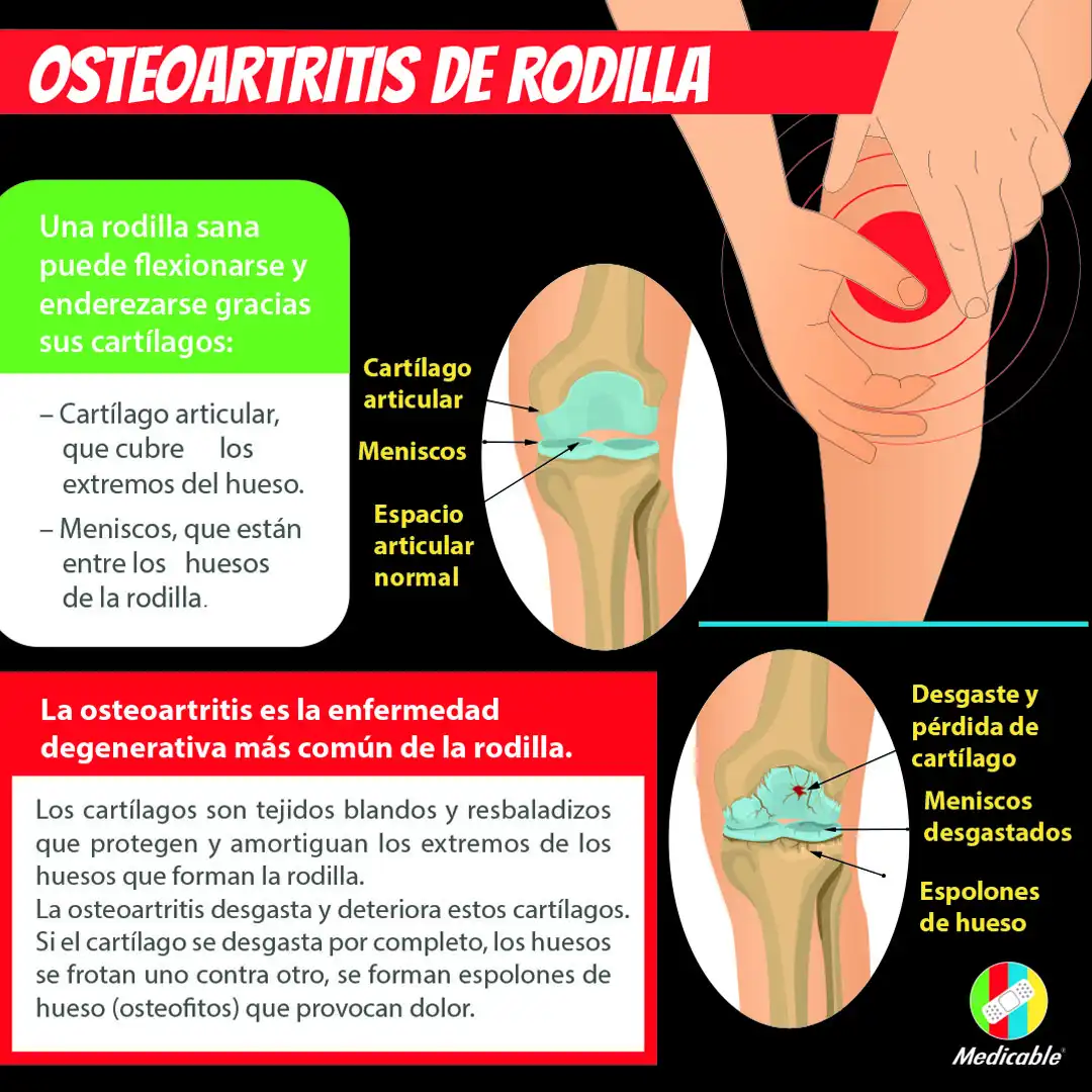 imagen de la infografia Osteoartritis de rodilla