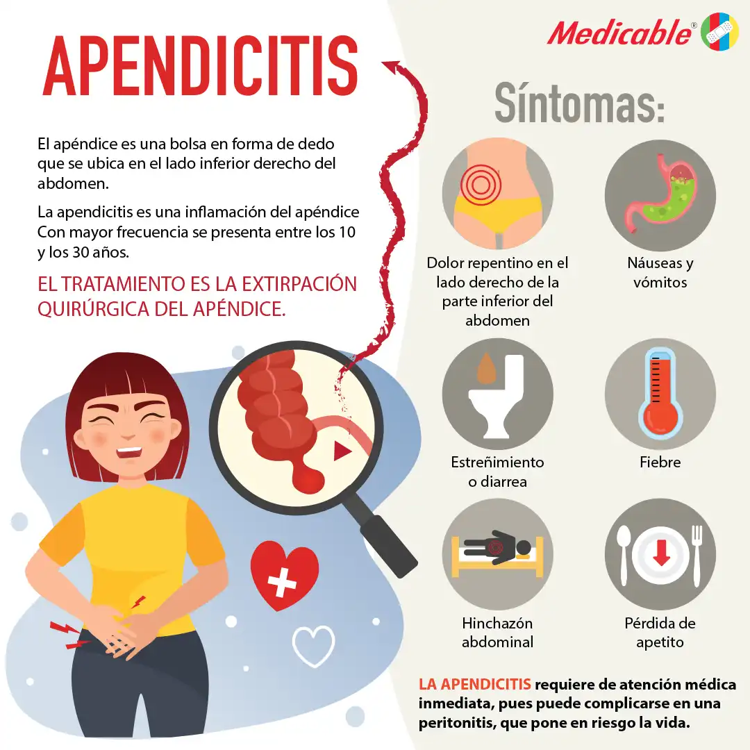 imagen de la infografia Apendicitis
