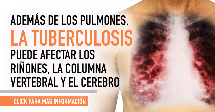 imagen de la infografia Tuberculosis